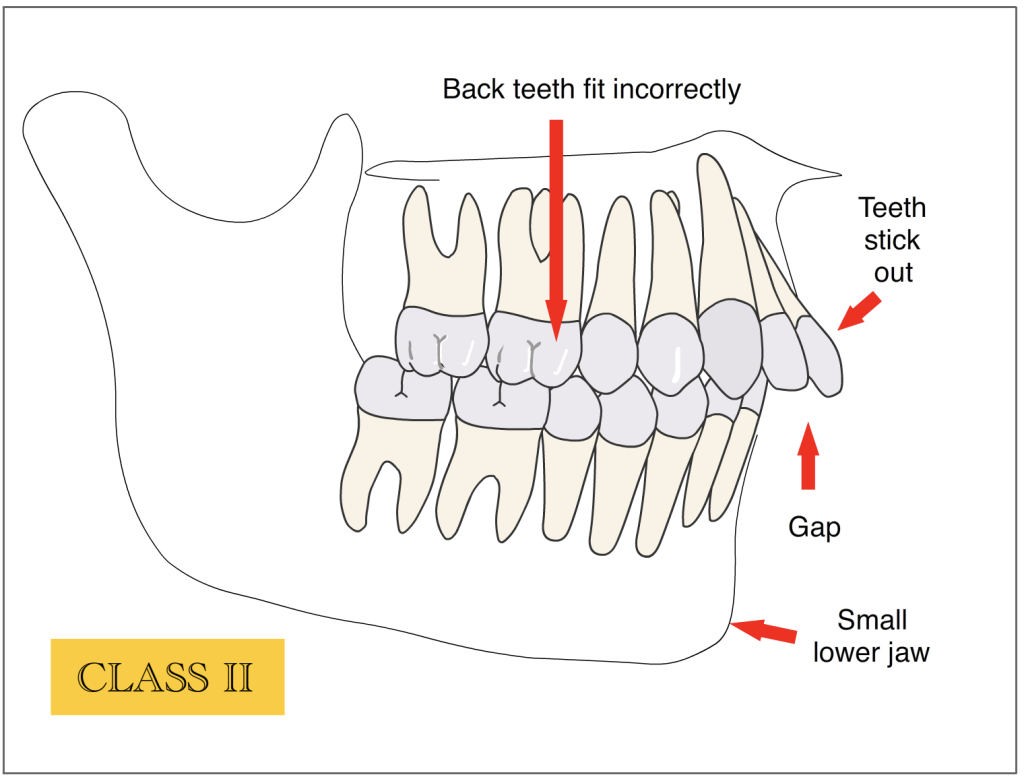 What is class 2 malocclusion? – Helios Orthodontics